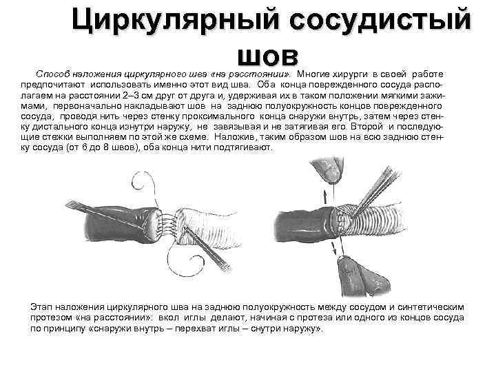 Циркулярный сосудистый шов Способ наложения циркулярного шва «на расстоянии» . Многие хирурги в своей