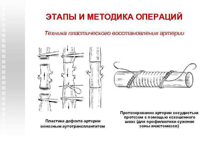 ЭТАПЫ И МЕТОДИКА ОПЕРАЦИЙ Техника пластического восстановления артерии Пластика дефекта артерии венозным аутотрансплантатом Протезирование