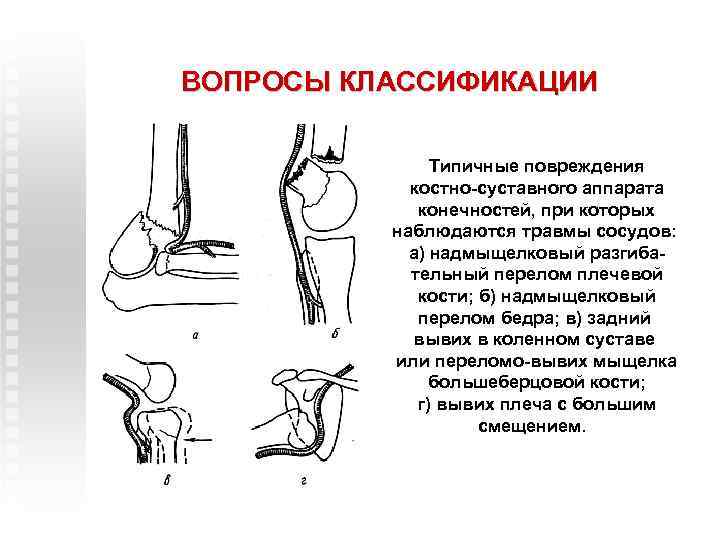 ВОПРОСЫ КЛАССИФИКАЦИИ Типичные повреждения костно-суставного аппарата конечностей, при которых наблюдаются травмы сосудов: а) надмыщелковый