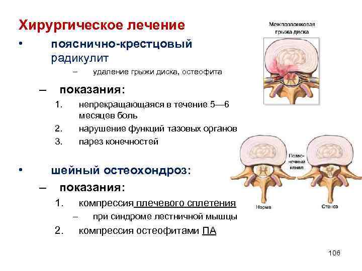 Схема лечения поясничного радикулита