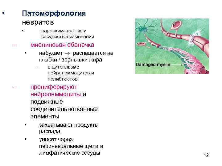  • Патоморфология невритов • паренхиматозные и сосудистые изменения – миелиновая оболочка • набухает