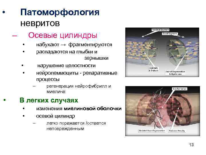  • Патоморфология невритов – Осевые цилиндры • • набухают → фрагментируются распадаются на