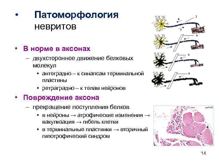  • Патоморфология невритов • В норме в аксонах – двухсторонное движение белковых молекул