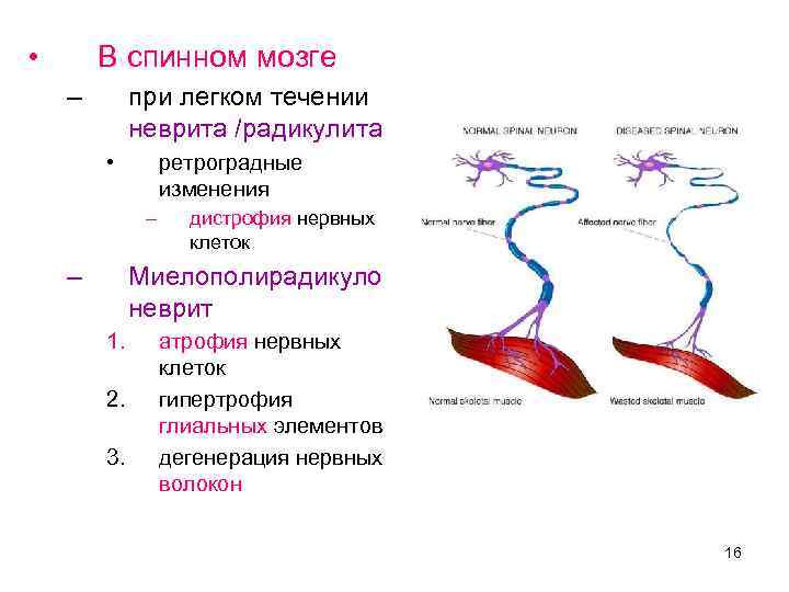 • В спинном мозге – при легком течении неврита /радикулита • ретроградные изменения