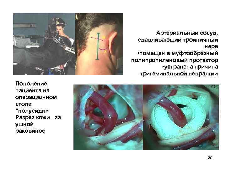Артериальный сосуд, сдавливающий тройничный нерв • помещен в муфтообразный полипропиленовый протектор • устранена причина