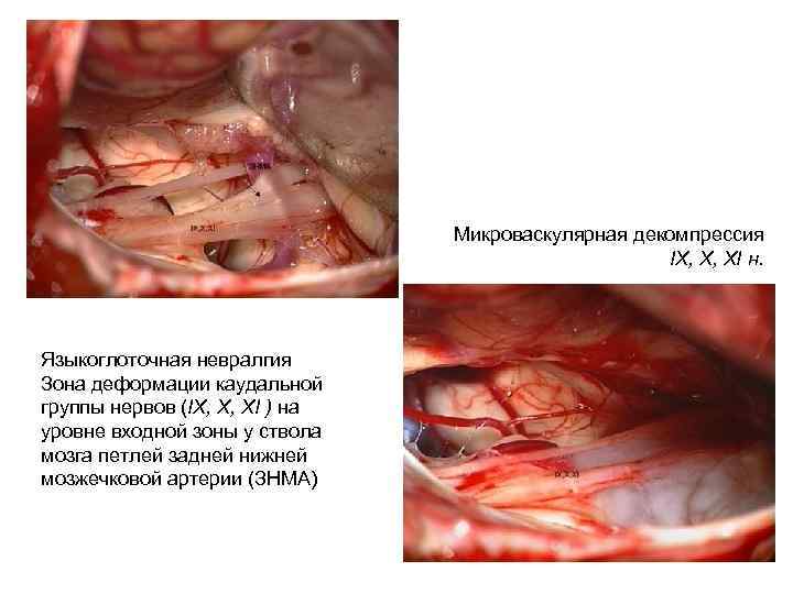 Микроваскулярная декомпрессия IX, X, XI н. Языкоглоточная невралгия Зона деформации каудальной группы нервов (IX,