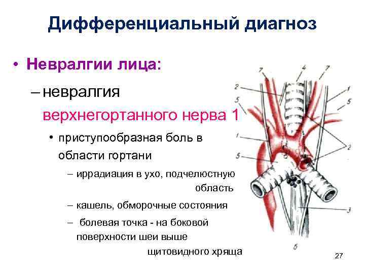 Приступообразная невралгия