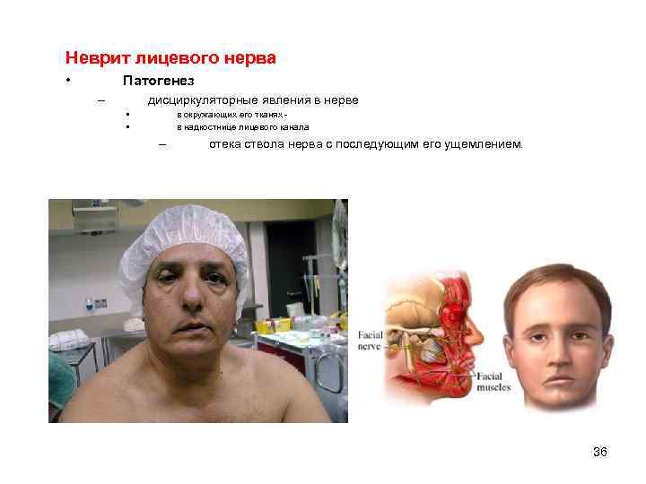 Неврит лицевого нерва • Патогенез – дисциркуляторные явления в нерве • • в окружающих