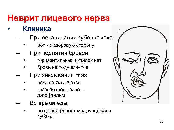 Неврит лицевого нерва • Клиника – При оскаливании зубов /смехе • – рот -