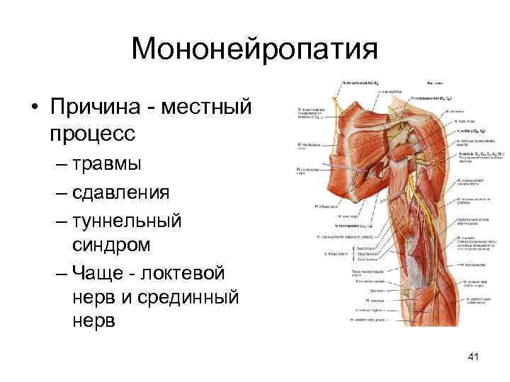 Мононейропатия • Причина - местный процесс – травмы – сдавления – туннельный синдром –