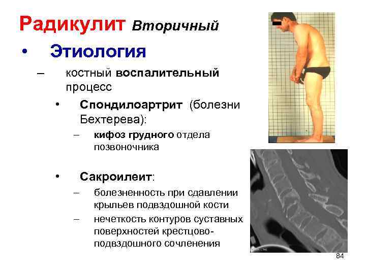 Радикулит Вторичный • Этиология – костный воспалительный процесс • Спондилоартрит (болезни Бехтерева): – •