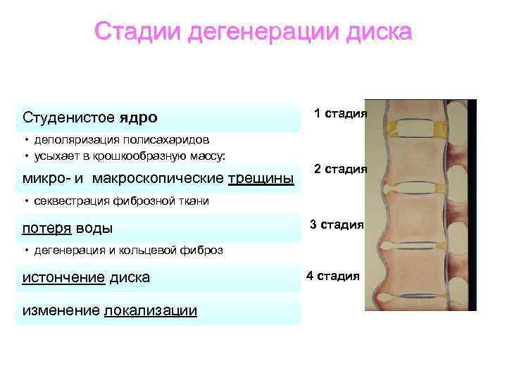 Дегенерация 3 степени