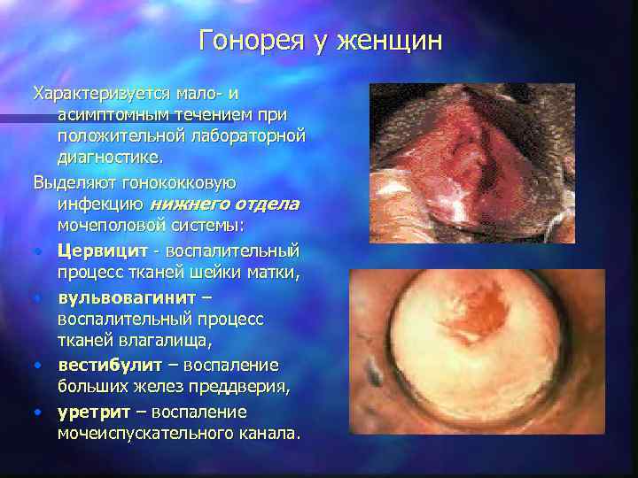 Гонорея у женщин Характеризуется мало- и асимптомным течением при положительной лабораторной диагностике. Выделяют гонококковую