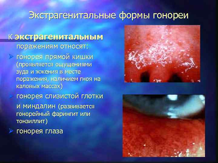 Экстрагенитальные формы гонореи К экстрагенитальным поражениям относят: Ø гонорея прямой кишки (проявляется ощущениями зуда