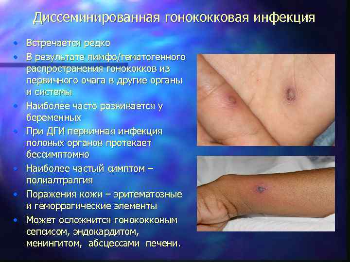 Диссеминированная гонококковая инфекция • Встречается редко • В результате лимфо/гематогенного распространения гонококков из первичного