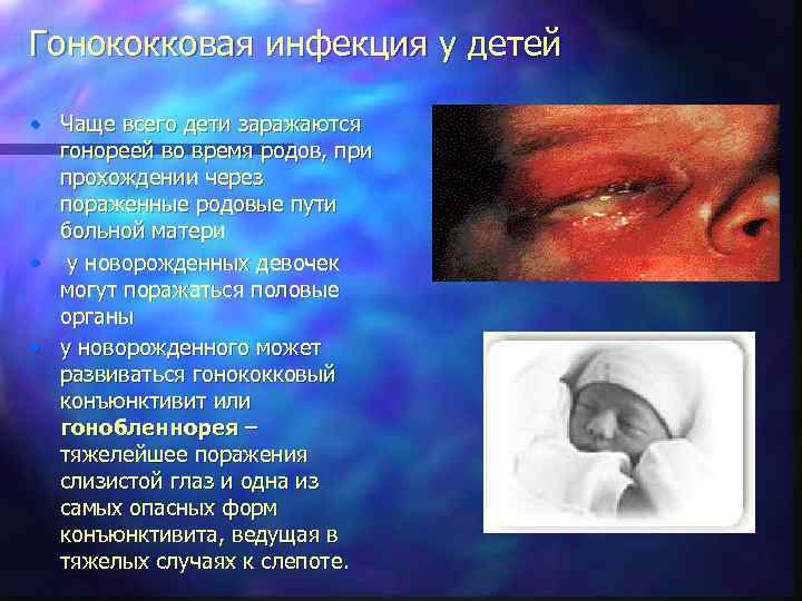 Гонококковая инфекция у детей • Чаще всего дети заражаются гонореей во время родов, при