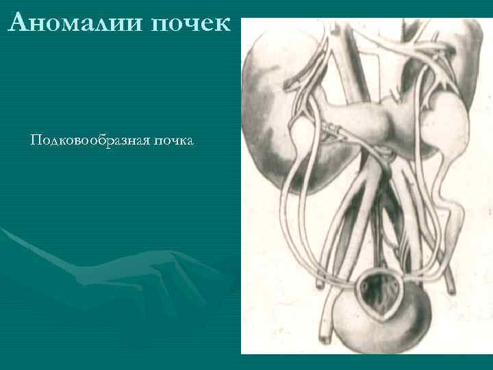 Аномалии почек Подковообразная почка 