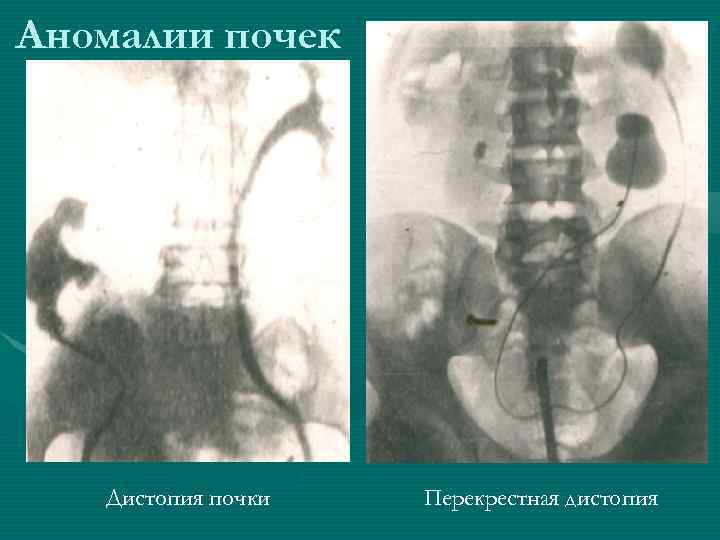 Аномалии почек Дистопия почки Перекрестная дистопия 