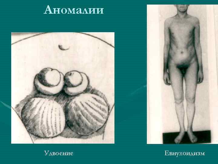 Аномалии Удвоение Евнухоидизм 
