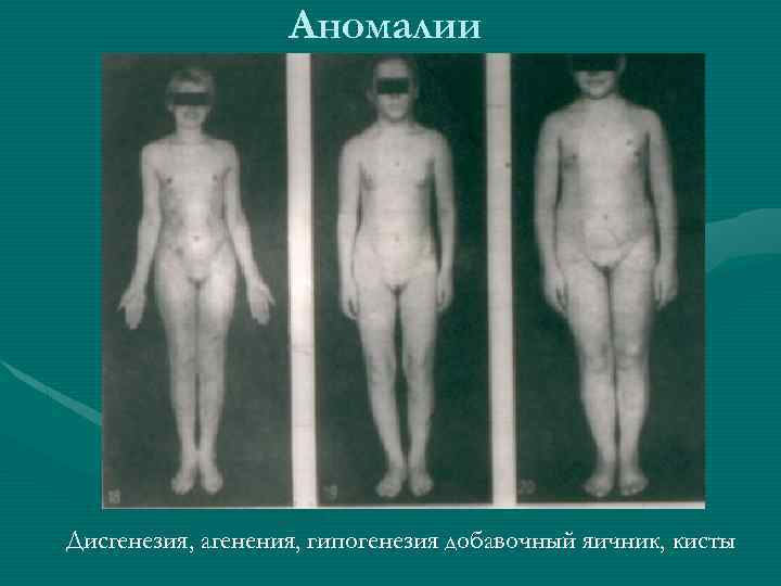 Аномалии Дисгенезия, агенения, гипогенезия добавочный яичник, кисты 