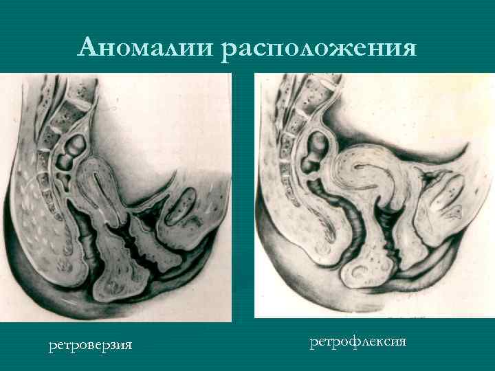 Аномалии расположения ретроверзия ретрофлексия 