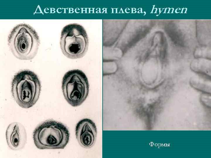 Девственная плева, hymen Формы 