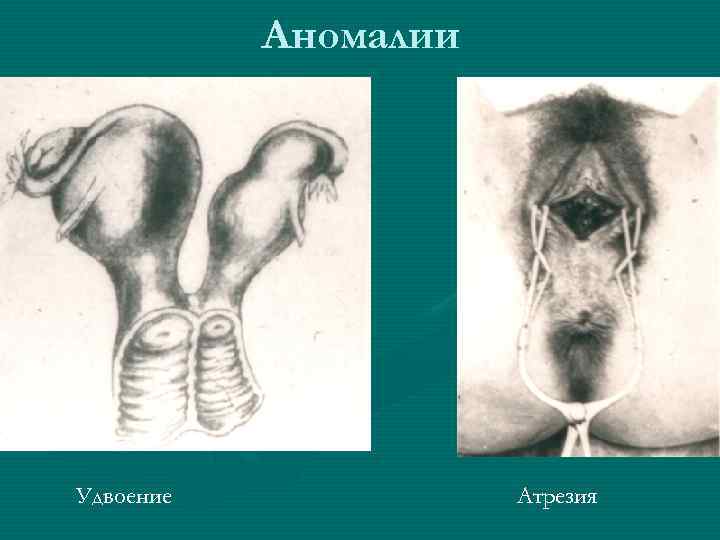 Аномалии Удвоение Атрезия 