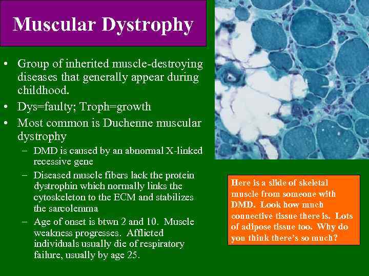 Muscular Dystrophy • Group of inherited muscle-destroying diseases that generally appear during childhood. •