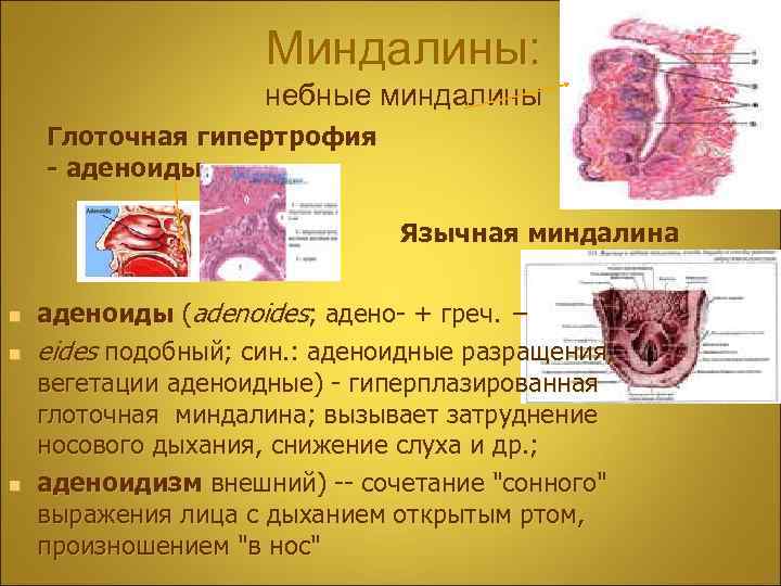 Миндалины: небные миндалины Глоточная гипертрофия - аденоиды Язычная миндалина n n n аденоиды (adenoides;
