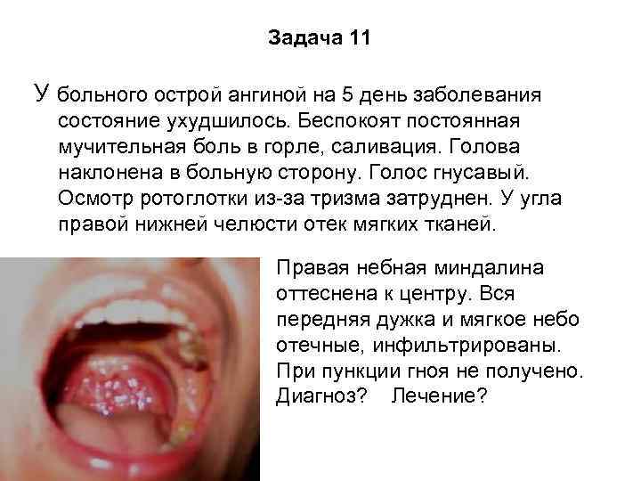 Задача 11 У больного острой ангиной на 5 день заболевания состояние ухудшилось. Беспокоят постоянная