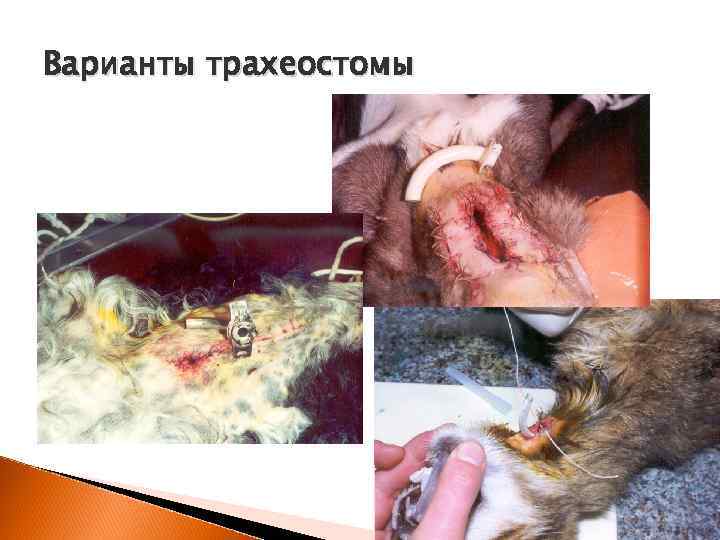 Варианты трахеостомы 