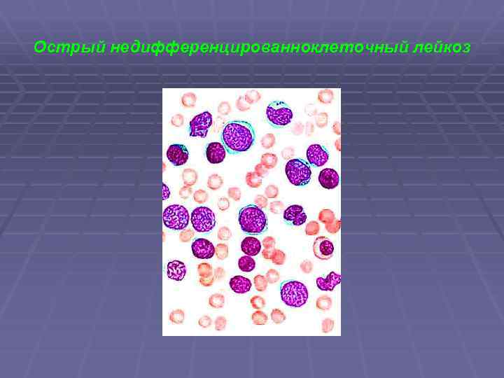 Острый недифференцированноклеточный лейкоз 