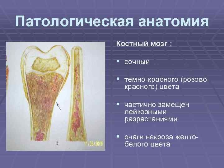 Патологическая анатомия § Костный мозг : § сочный § темно-красного (розовокрасного) цвета § частично