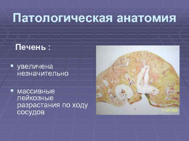 Патологическая анатомия Печень : § увеличена незначительно § массивные лейкозные разрастания по ходу сосудов