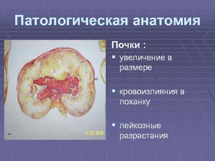 Патологическая анатомия Почки : § увеличение в размере § кровоизлияния в лоханку § лейкозные