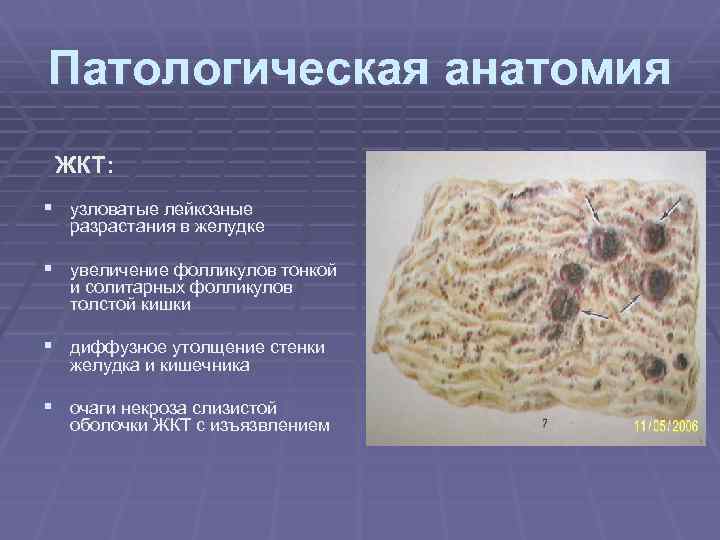 Патологическая анатомия ЖКТ: § узловатые лейкозные разрастания в желудке § увеличение фолликулов тонкой и