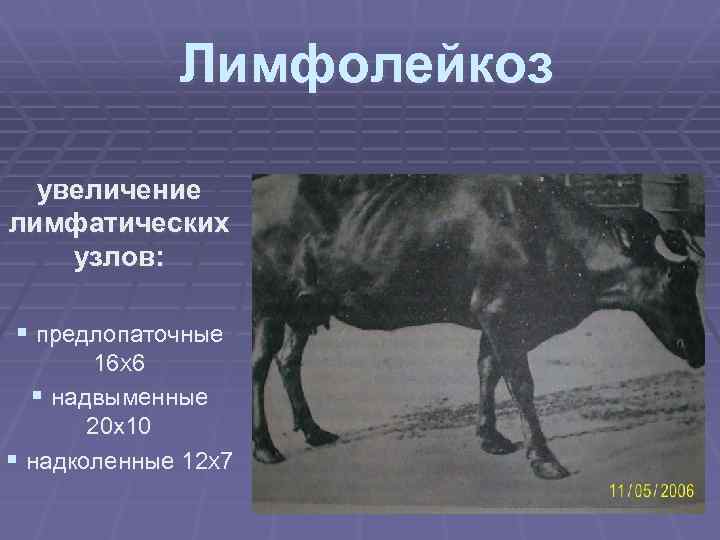 Лимфолейкоз увеличение лимфатических узлов: § предлопаточные 16 Х 6 § надвыменные 20 х10 §