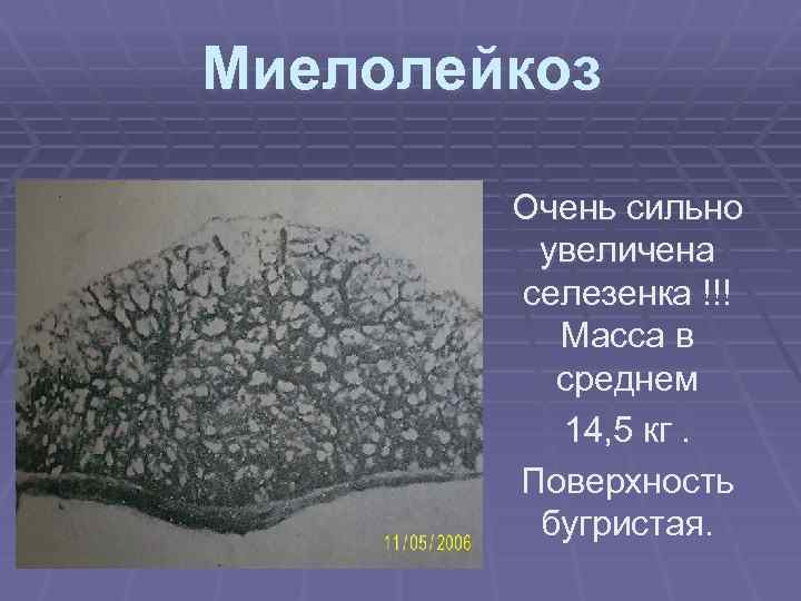 Миелолейкоз Очень сильно увеличена селезенка !!! Масса в среднем 14, 5 кг. Поверхность бугристая.