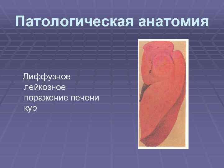 Патологическая анатомия Диффузное лейкозное поражение печени кур 