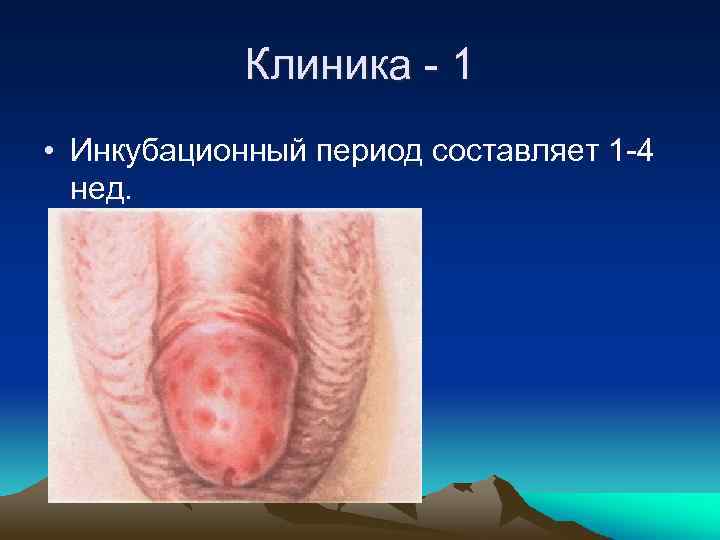 Клиника - 1 • Инкубационный период составляет 1 -4 нед. 