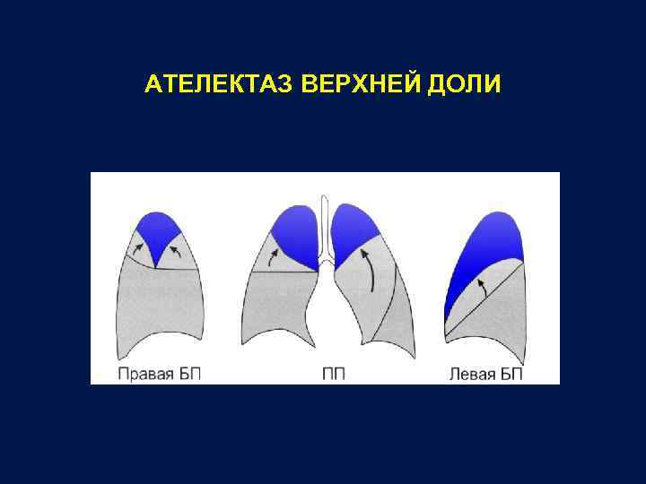 Ателектазы рентген схема