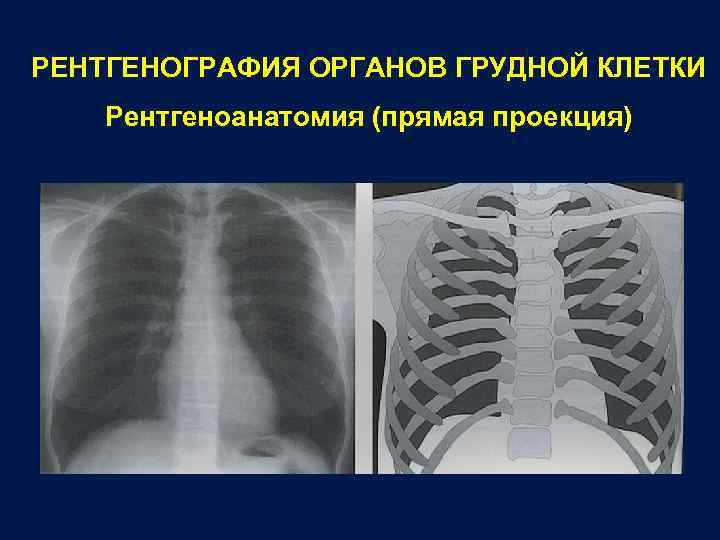 РЕНТГЕНОГРАФИЯ ОРГАНОВ ГРУДНОЙ КЛЕТКИ Рентгеноанатомия (прямая проекция) 