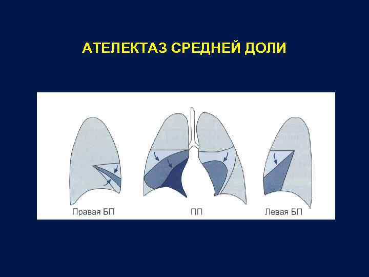 Рентген легких схема