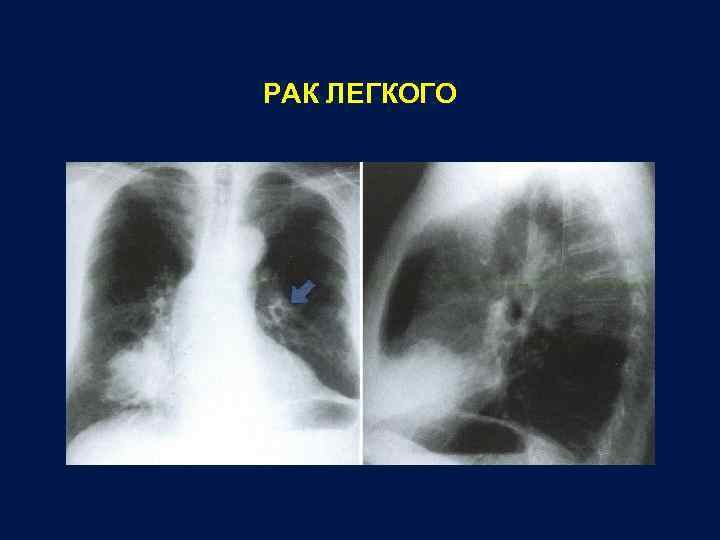 Как на рентгене выглядит рак легких фото