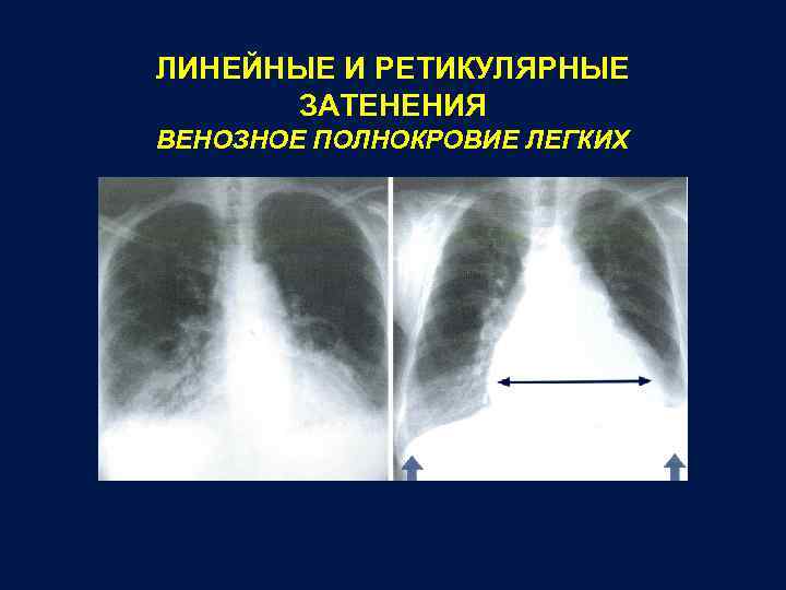 ЛИНЕЙНЫЕ И РЕТИКУЛЯРНЫЕ ЗАТЕНЕНИЯ ВЕНОЗНОЕ ПОЛНОКРОВИЕ ЛЕГКИХ 