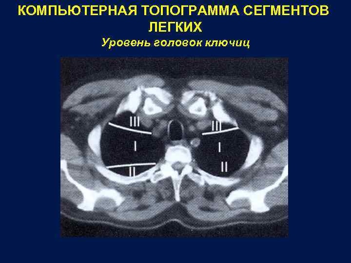 КОМПЬЮТЕРНАЯ ТОПОГРАММА СЕГМЕНТОВ ЛЕГКИХ Уровень головок ключиц 