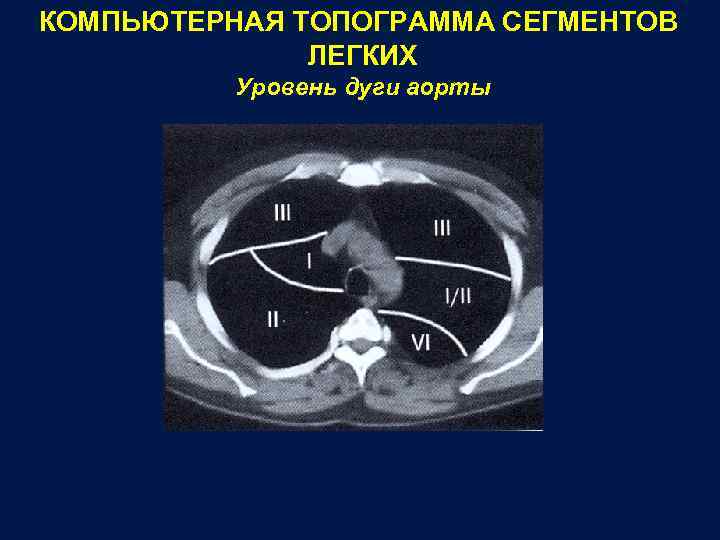 КОМПЬЮТЕРНАЯ ТОПОГРАММА СЕГМЕНТОВ ЛЕГКИХ Уровень дуги аорты 