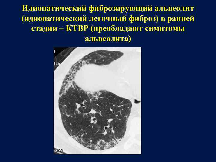 Идиопатический фиброзирующий альвеолит (идиопатический легочный фиброз) в ранней стадии КТВР (преобладают симптомы альвеолита) 