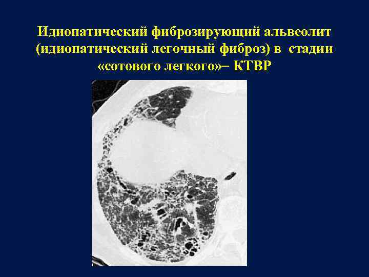 Идиопатический фиброзирующий альвеолит (идиопатический легочный фиброз) в стадии «сотового легкого» КТВР 