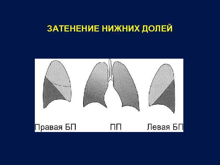 Нижние доли легких. Ателектаз средней доли правого легкого на кт. Ателектаз верхней доли слева рентген. Ателектаз средней доли правого легкого схема. Ателектаз верхней доли левого легкого схема.